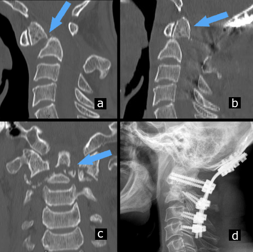A nyaki gerinc csontritkulásának kezelése