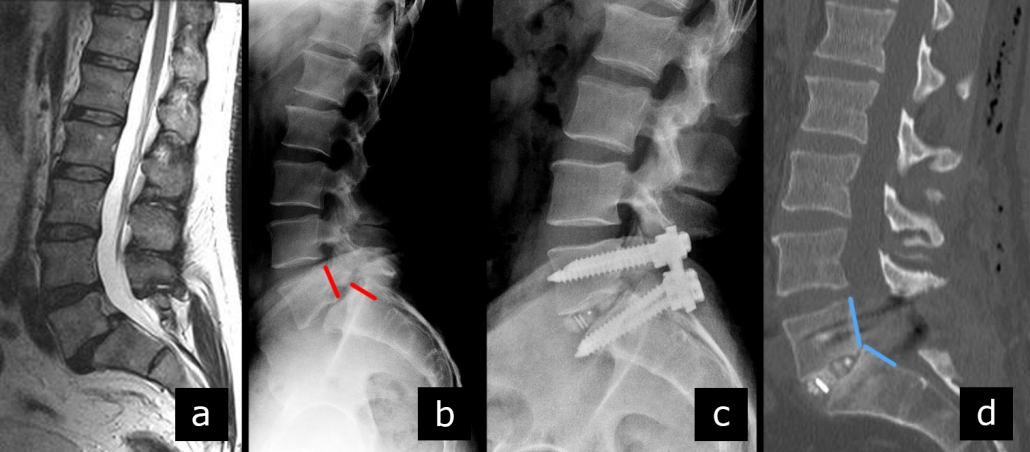 Az elcsúszott gerinc csigolyát helyre tudja rakni csontkovács?